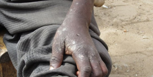 Centrafrique : Le Centre de santé de Gouzé à 20 km de Paoua enregistre au moins 580 cas de maladie de gale